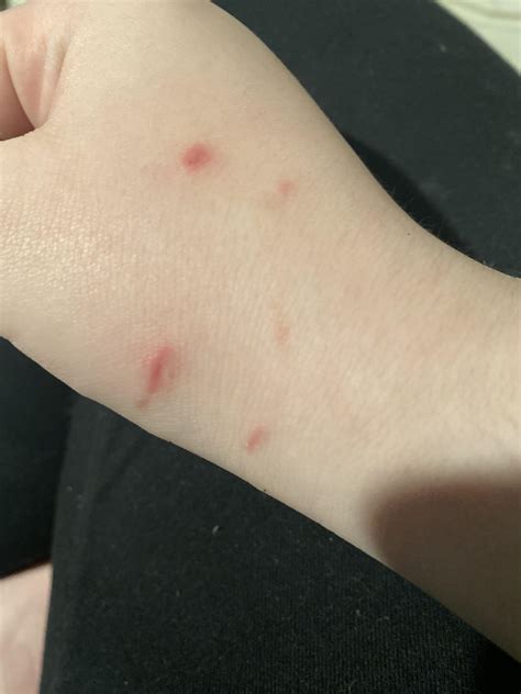 Cat Bite Update Thanks For All The Help Rmedicaladvice