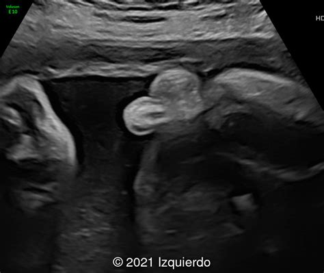 Ambiguous Genitalia Ultrasound