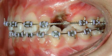 Vu Orthodontics Lasers