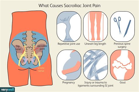 Un aperçu de la douleur articulaire sacro iliaque Fmedic
