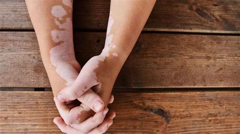 Vitiligo Conheça A Doença Que Causa Manchas Brancas Na Pele
