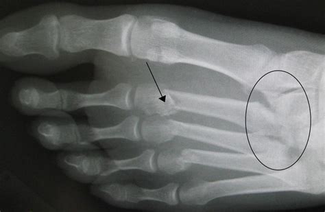 Lisfranc Fracture Causes Symptoms And Treatment