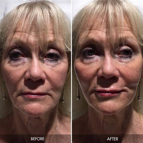 Our Treatment Results Patients Before And After Photos