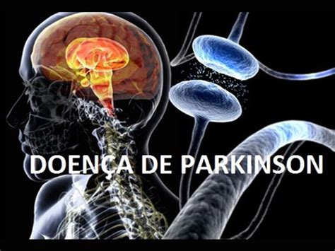O Que é A Doença De Parkinson