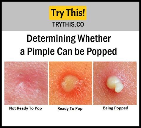 Pop Pimple
