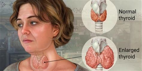 घेंघा Goiter रोग Enlarged Thyroid Gland के लक्षण कारण और इलाज