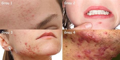 Graus Da Acne Conheça A Causa E Os Tratamentos Dicas Da Jaque Acne