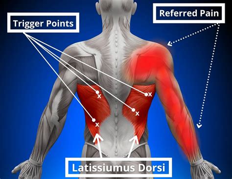 How To Fix Latissimus Dorsi Pain Facts And Physio