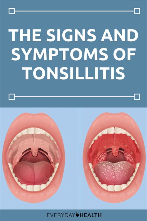 How Do You Know If You Have Tonsillitis Symptoms Of Tonsillitis