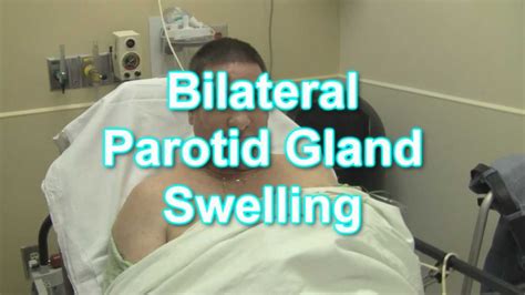 Bilateral Parotid Gland Swelling Youtube