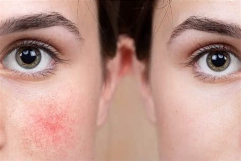 How To Get Rid Of Redness On Face Md Tips Smart Style Today