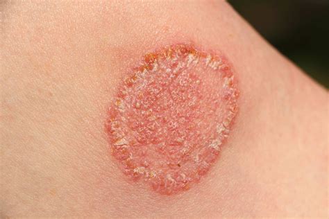 Fungal Infections — Fora Dermatology General And Surgical Dermatology