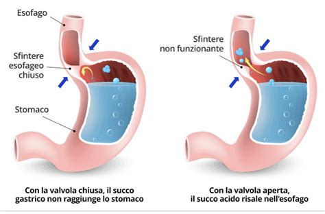 Reflusso Gastro Esofageo E Osteopatia Osteopata Simonetta Alibrandi
