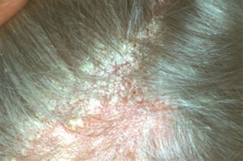 Seborrheic Dermatitis Scalp Hair Loss