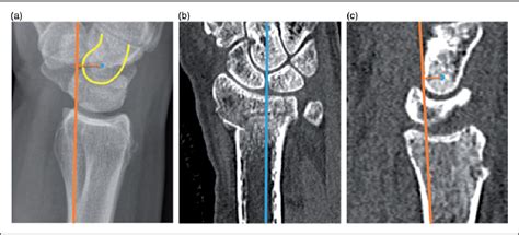 Figure 2 From Comparison Of Extra Articular Radiographic Parameters Of