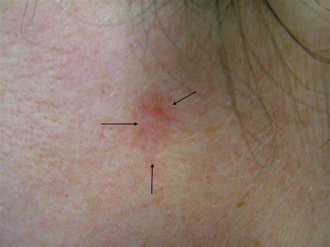 Basal Cell Skin Cancer On Back