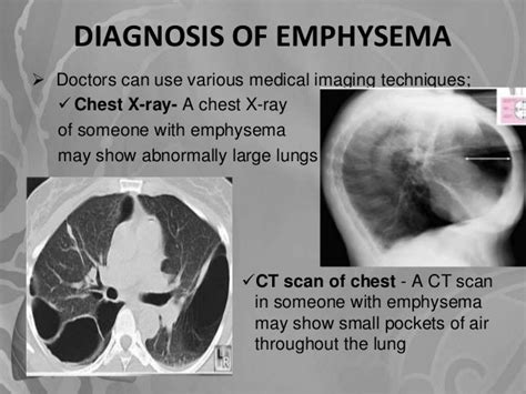 Emphysema