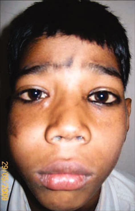 A Young Boy With A Maxillary Swelling And Closed Rhinolalia Bmj Case