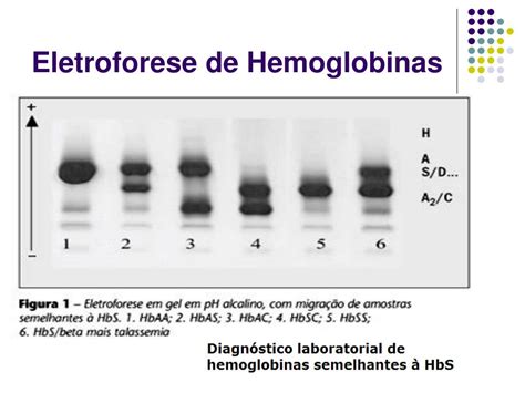 Ppt Anemias Hemol íticas Hemoglobinopatias Powerpoint Presentation