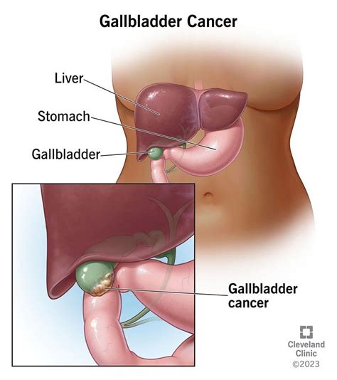 Gallbladder Cancer Symptoms Treatment Prognosis