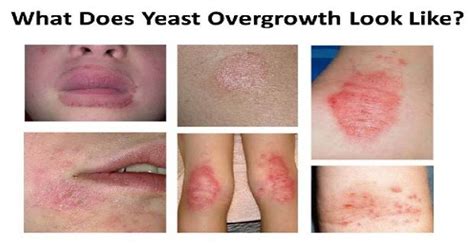 7 Causes Of Candida Overgrowth Yeast Overgrowth Candida Overgrowth