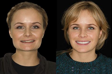 Orthognathic Facial Asymmetry Correction Corrective Jaw Surgery Dr Antipov