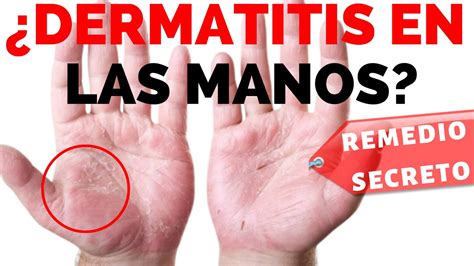 👋 Como Curar La Dermatitis En Las Manos Remedio Secreto Revelado
