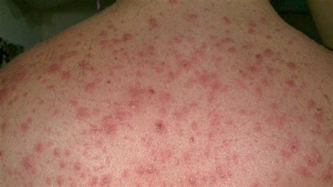 Erythema Multiforme Pictures Causes Treatment And More