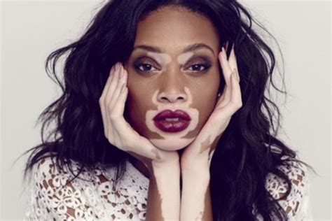 All Things That You Need To Know About Vitiligo