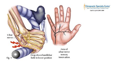 Ulnar Nerve Entrapment Images