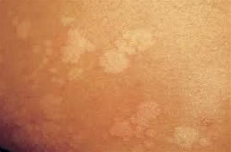 White Spots On Skin 9 Common Causes With Treatments