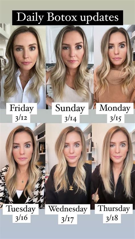 Blogger Opens Up About Her Experience With Ptosis A Rare Botox Side