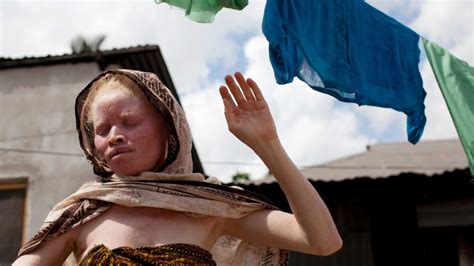 The ‘silent Killer Of Africas Albinos Bbc Future