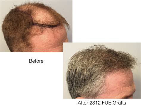 FUE Hair Transplant In Norwood 6 Patient Marc Dauer MD Hair