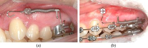 Miniscrew Applications In Orthodontics Intechopen