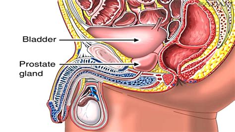 Enlarged Prostate Gland Benign Prostatic Hyperplasia Animation Symptoms And Treatment Of Bph