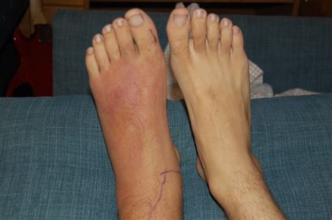 Cellulitis Craigs Foot Infection Nicole Daniliuk Flickr