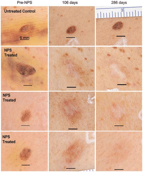 Pigmented Seborrheic Keratoses From A Single Subject Shown Before