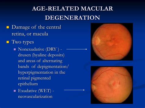 Ppt Age Related Macular Degeneration Powerpoint Presentation Free