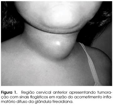 Scielo Brasil Tireoidite Bacteriana Supurativa Relato De Caso E My