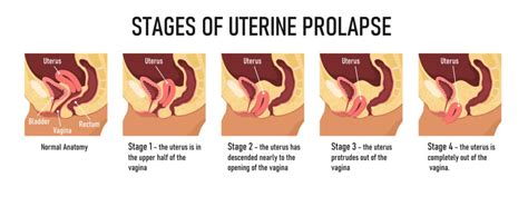The Different Stages Of Pelvic Organ Prolapse Nancy Branberg Pt