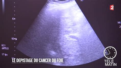Santé Le Dépistage Du Cancer Du Foie 20150931 Youtube
