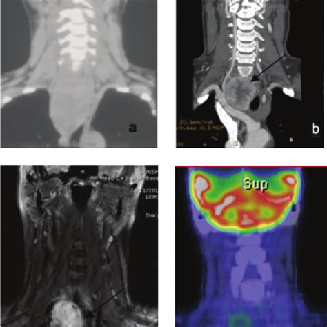 Neck Computed Tomography Ct Without Contrast A Showing Homogenous