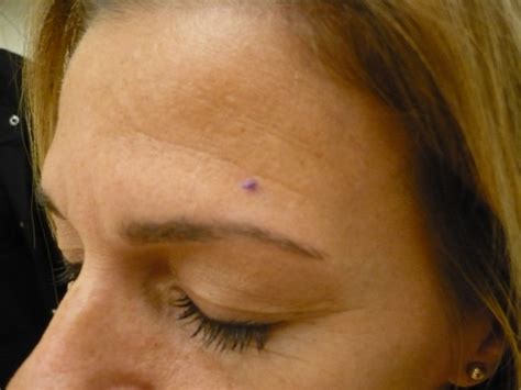 Skin Cancer On Forehead
