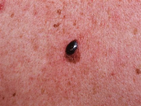 Skin As Related To Melanoma Pictures