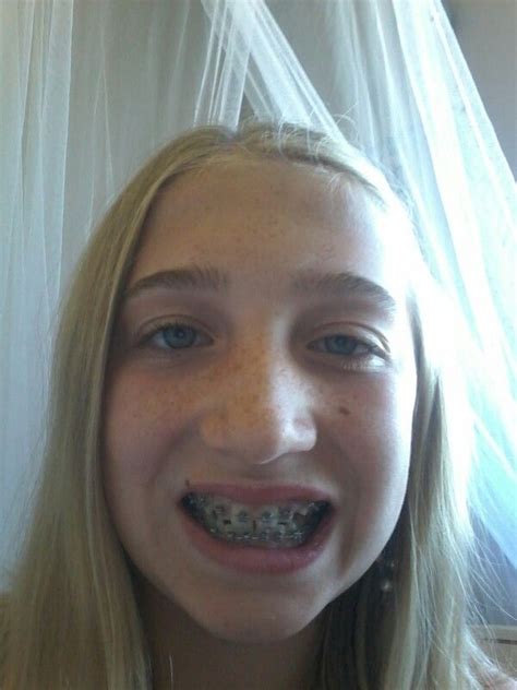 This Is Me With Braces Beautiful Mess Lovely Teen Girl Poses Pretty Selfies Orthodontics