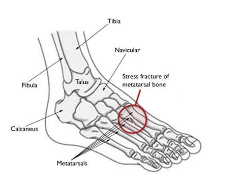 Mr imaging can be particularly helpful for the diagnosis and characterization of osseous stress injuries in the foot and ankle. Stress Fractures of the Foot and Ankle - OrthoInfo - AAOS