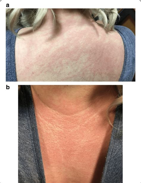 Clinical Features Of Dermatomyositis With Shawl Like Rash Affecting