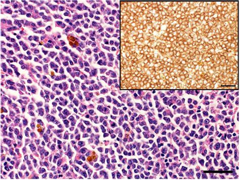 These are types of lymphoma that affect t lymphocytes. Enteropathy-associated canine T-cell lymphoma, large cell ...