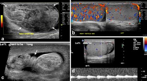 Testicular Torsion With Preserved Flow Key Sonographic Features And Value Added Approach To